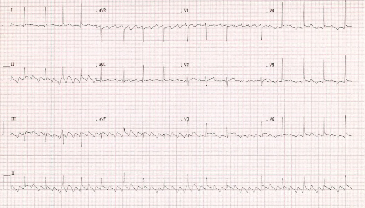Atrial flutter with variable conduction