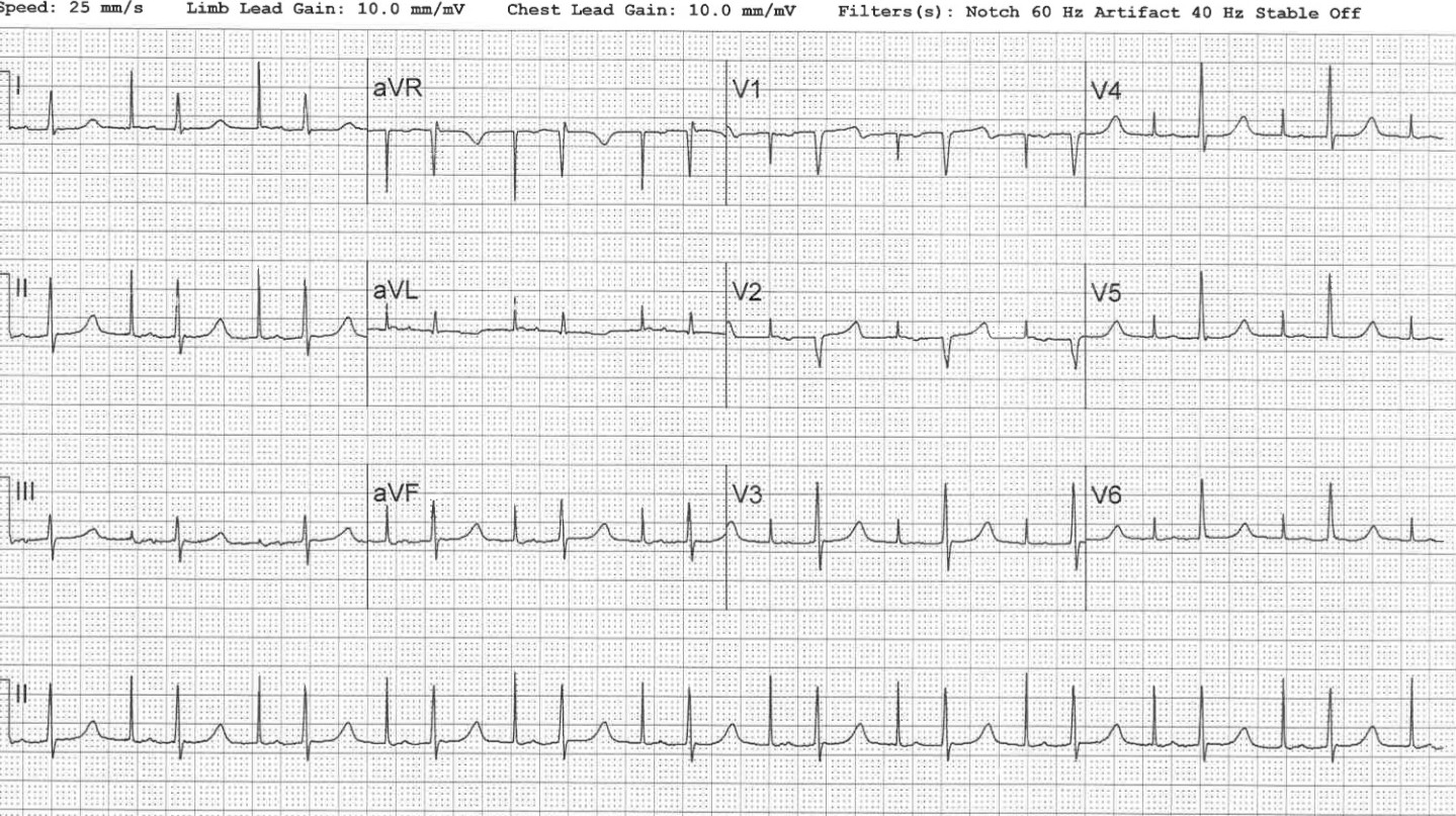 Sick Sinus Syndrome with Atrial Pacing